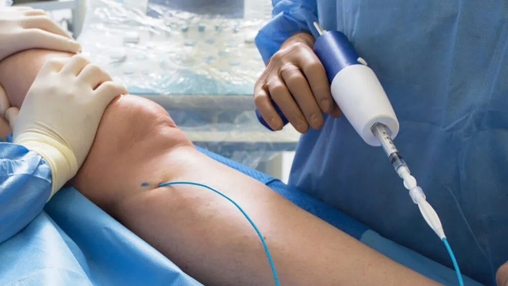 Fotó a ragasztásos visszérműtét lépéséről