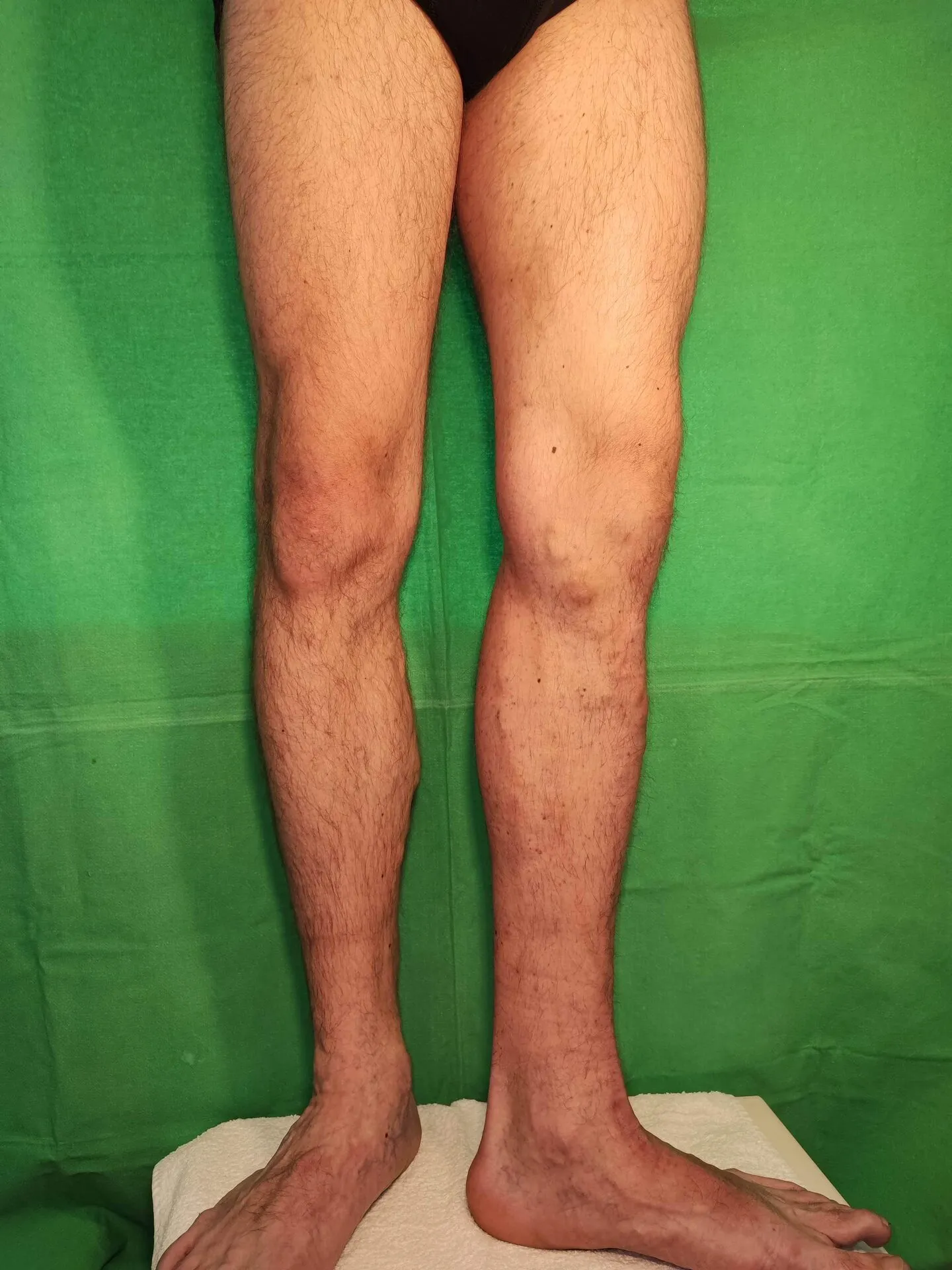 Gz eset – visszér kezelés utáni fotó