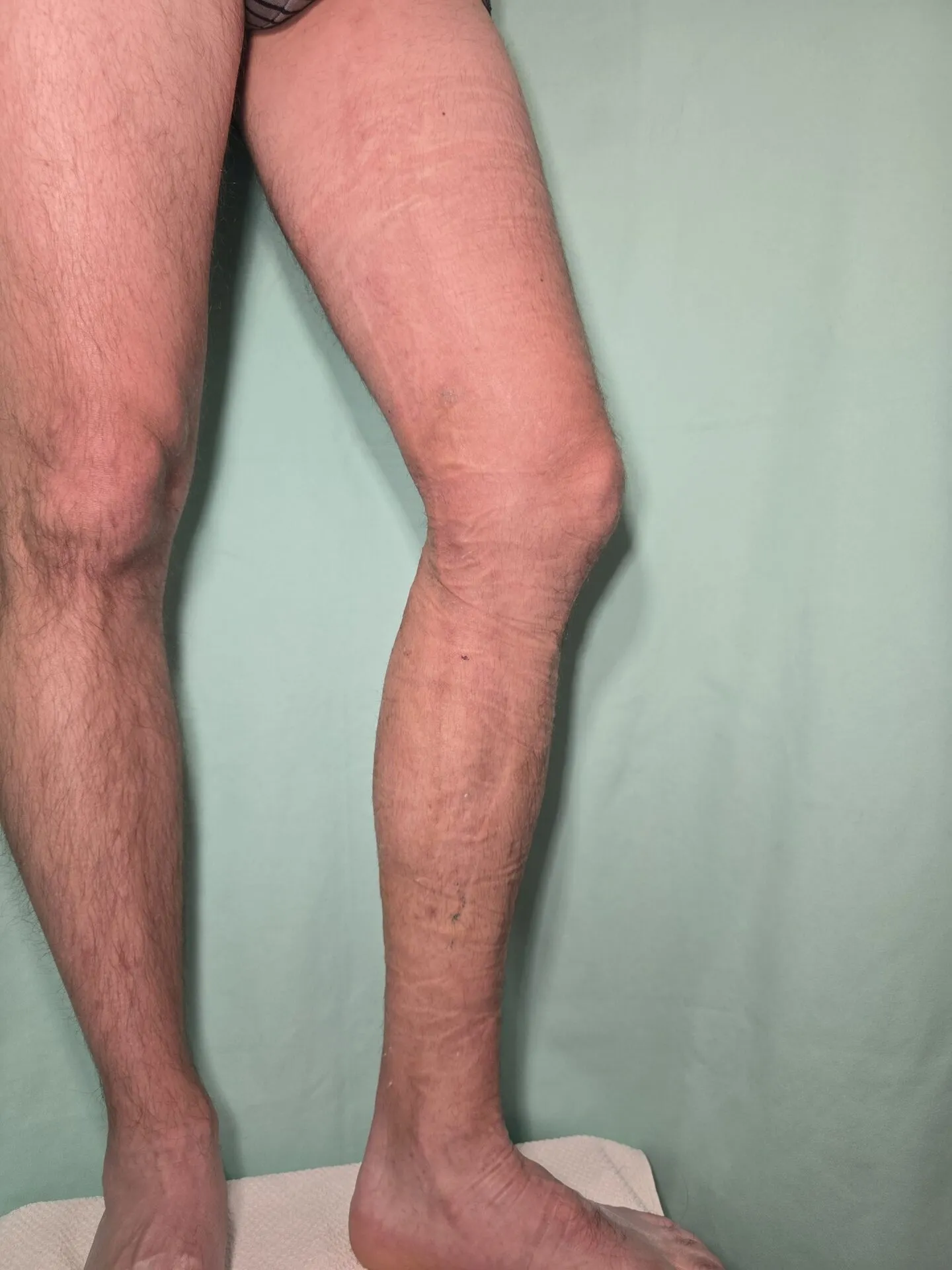 KB eset – szkleroterápia utáni állapot