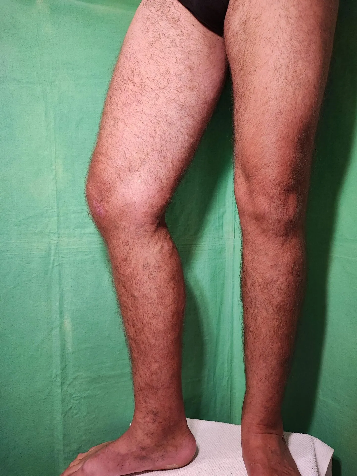 Ud eset – visszér kezelés utáni fotó