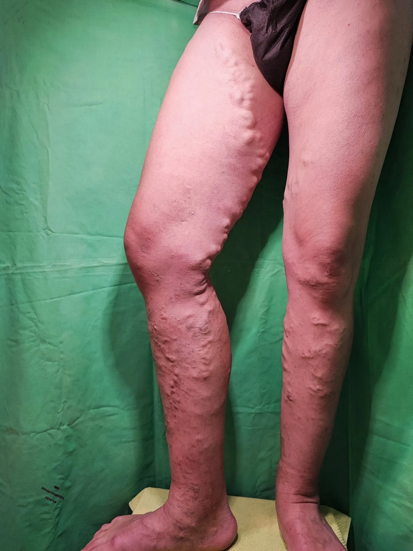 Ud eset – visszér kezelés előtti fotó