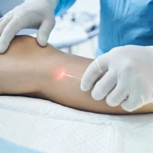 Fotó lézeres visszérkezelésről a rendelőben